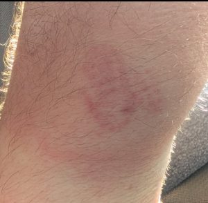 insect sting on arm