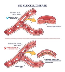 Sickle cell disease with abnormal red blood cell shape outline diagram. Labeled educational scheme with medical disease and chronic vascular condition vector illustration. Blood flow block closeup.