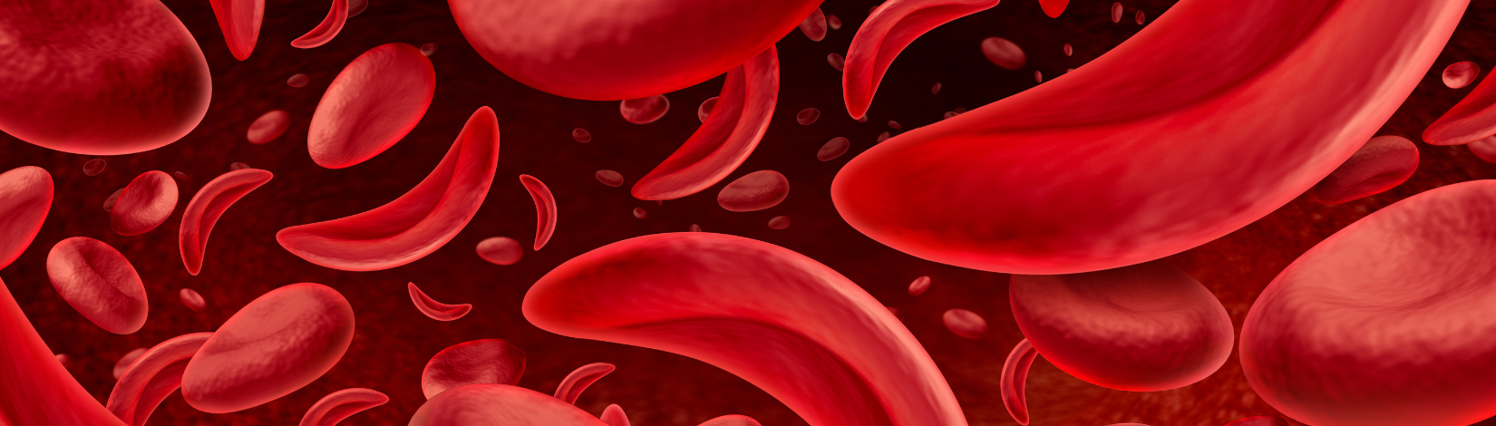 Sickle cell anemia as a red blood disease as a normal and abnormal hemoglobin anatomy medical illustration concept