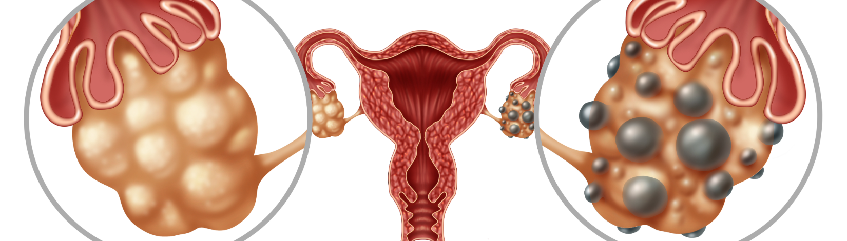 Polycystic Ovarian Syndrome or now known as PMOS on ovaries symptoms as hormonal disorder with small ovarian cysts as a concept of female fertility
